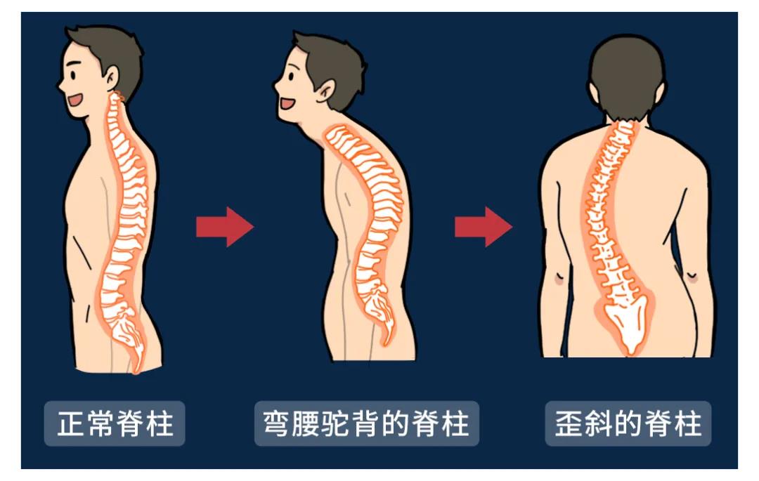 歪斜的脊柱